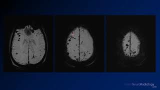 Neuroradiology board review 3 case 16 [upl. by Naves]