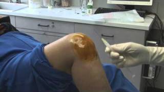 Knee Injection HDmp4 [upl. by Turne]