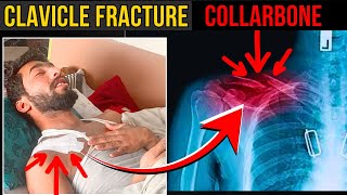 clavicle fracture  collarbone fracture  clavicle fracture natural healing [upl. by Wystand]