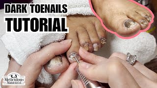 Why do Toenails turn Black nails satisfying [upl. by Atahs637]