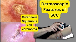 Dermoscopic features of SCCSquamous Cell Carcinoma [upl. by Atinauj988]