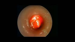 Destruction de granulome au dessus dune canule de trachéotomie par laser [upl. by Sirk563]