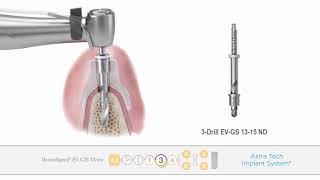 Astra Tech Implant System™ EV Guided surgery  Implant placement  Dentsply Sirona [upl. by Hgeilhsa]