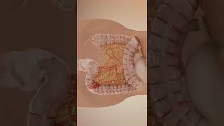 Colon cancer sigmoid colectomy medical nursing youtubeshorts shorts cancer oncology colon [upl. by Mychael]