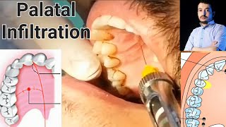 Local Anesthesia Palatal Infiltration Technique Maxillary Anesthesia Techniques dentistry [upl. by Kleper]