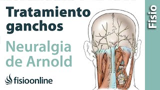 Tratamiento de fisioterapia con ganchos para la neuralgia de Arnold o neuralgia occipital [upl. by Euseibbob]