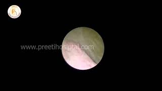 Thulium Fiber Laser Lithotripsy for 2 5cm pelvic stone [upl. by Aran375]