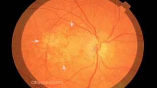 Macular Degeneration and the Aging Retina [upl. by Ailahtan]