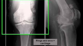 26 Soft Tissue Calcifications 1 [upl. by Errot355]