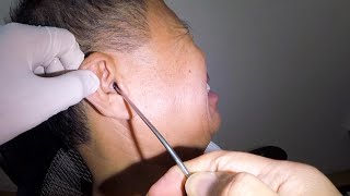 Removing Mans Earwax By Applying Hydrogen Peroxide  Can It Soften A Hard Earwax [upl. by Anaerda352]