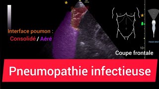 Pneumopathie Consolidation Échographie pulmonaire [upl. by Nan]