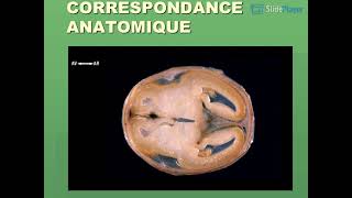 Mesures par échographie Biométrie fœtale [upl. by Enitselec839]