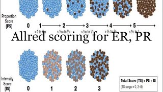 ALLRED Scoring for ER PR in Breast Cancer [upl. by Yanaton981]