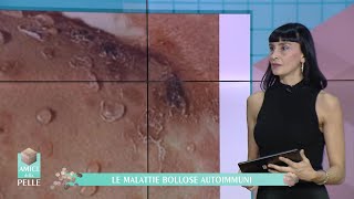 LE MALATTIE BOLLOSE AUTOIMMUNI [upl. by Bautista112]