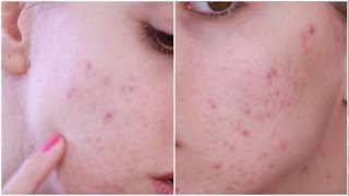 ACNE DIARY Terzo Mese di Isotretinoina [upl. by Aitnis363]