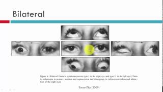 Duanes Retraction Syndrome Classification [upl. by Ferri]