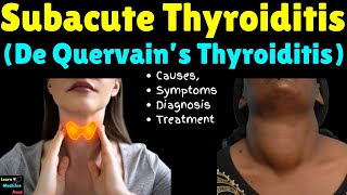 Subacute Thyroiditis De Quervain’s Thyroiditis – Causes Symptoms Diagnosis and Treatment [upl. by Aicined]