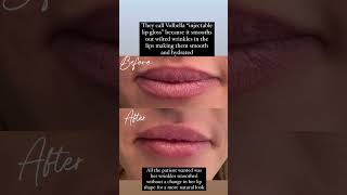 Natural lip injections volbella lipfiller lipfillerinjections [upl. by Aneela]