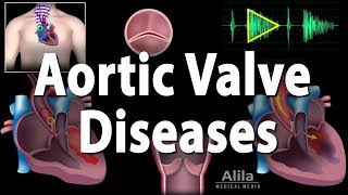 Aortic Valve Disease Animation [upl. by Tennies]