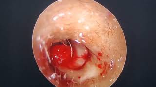 endoscopic tympanoplasty [upl. by Hiram]