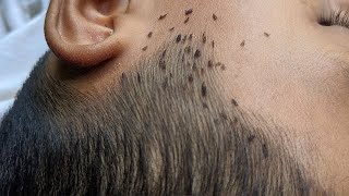 How to get rid hundred lice from short hair  Remove all big lice from black hair [upl. by Notneuq]