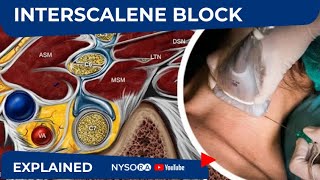 NYSORA Regional Anesthesia Interscalene Block [upl. by Serg]