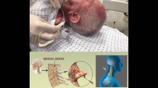 CERVICAL RADIOFREQUENCY ABLATION [upl. by Novad]