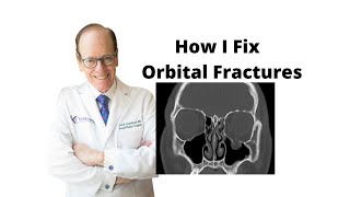 Orbital Fractures 101  Oculoplastic Surgeon Explains Orbital Fracture Surgery [upl. by Aneert]