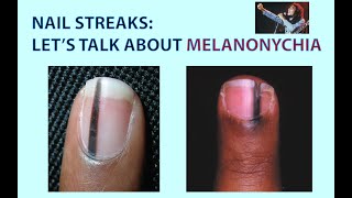 Streaks in Your Nails Lets Talk about Melanonychia Well Also Look at Skin Tags amp Skin Polyps [upl. by Aicnerolf]