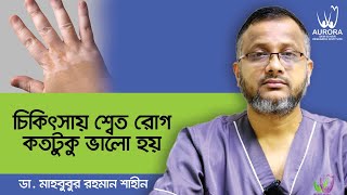 Vitiligo treatment in Bangladesh  Vitiligo treatment bangla  বাংলাদেশে শ্বেত রোগের আধুনিক চিকিৎসা [upl. by Remy]