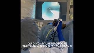 Ureteroscopy with Laser Lithotripsy  Treating Kidney Stones  Real Procedure Footage [upl. by Suoicerp]