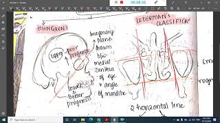 paranasal sinus tumors  ENT [upl. by Pattani323]