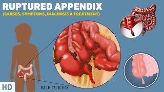 Ruptured Appendix What It Feels Like and How to Recognize the Symptoms [upl. by Aratahs]