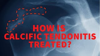 How is calcific tendonitis treated [upl. by Agn]