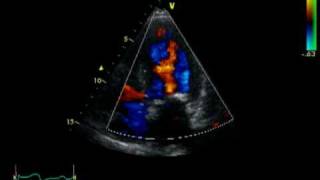 HOCM  AORTIC STENOSIS  LVOT FLOW [upl. by Nerag242]