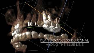 CBCT guided endodontic access [upl. by Alicec455]