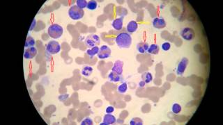 Chronic Eosinophilic Leukemia [upl. by Nire]