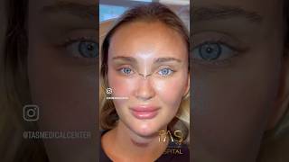 Scarless facelift and rhinoplasty by DrTAS drsuleymantas tasmedicalcenter scarlessfacelift [upl. by Novad]