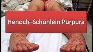 HenochSchönlein Purpura [upl. by Rufe138]