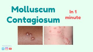 Molluscum Contagiosum Causes symptoms and treatment [upl. by Pearce]