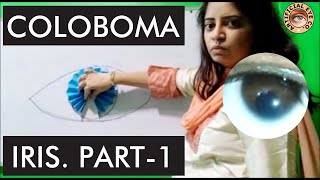 Iris coloboma  What is Coloboma  Treatment  Dr Sumitra  Hindi  Part 1 [upl. by Yznyl]