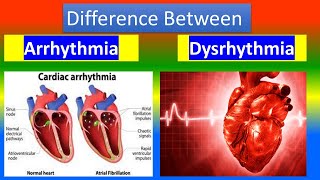 ARRHYTHMIA Vs DYSRHYTHMIA [upl. by Adnil281]