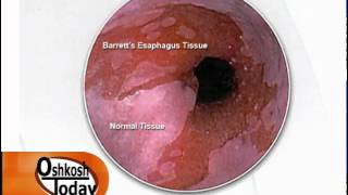 Barretts Esophagus [upl. by Ligetti]