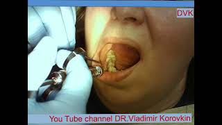 Infiltration anesthesia for treatment 44 toothlocalanaesthesia nerveblock [upl. by Geminius]