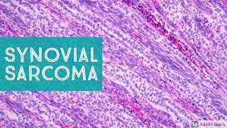 Synovial Sarcoma 101…Explained by a Soft Tissue Pathologist [upl. by Gemma208]