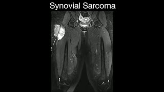 Synovial Sarcoma 1 [upl. by Harikahs]