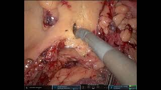 Robotic Left Hemicolectomy  Unedited intracorporeal anastomosis [upl. by Dibb]