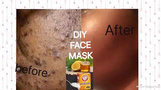 Get rid of Acne amp hyper pigmentation  baking sodalemon amp honey skin care routine [upl. by Shelden]