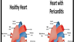 Pericarditis cardiovascular diseasesdisorders series‎Theaiims01 [upl. by Iru816]