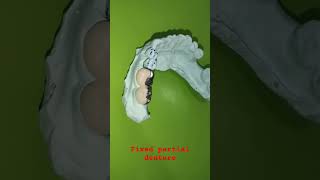 fixed partial dentureacrylic facing metal capviral videoshort videodentaltreatment dental [upl. by Aidil]